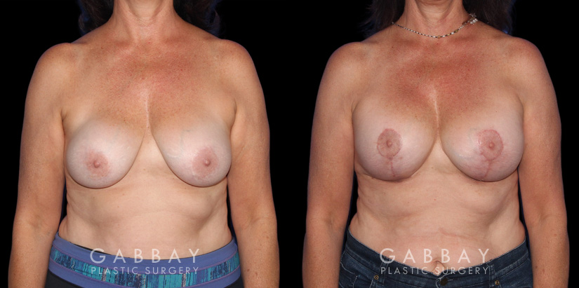 Procedures Depicted:  R&R + Breast Lift