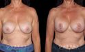 Procedures Depicted:  R&R + Breast Lift
