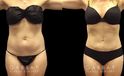 Front and side views of before and after liposuction for female patient. The surgery resulted in a flatter stomach with no notable bulging pockets of fat.