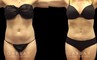 Front and side views of before and after liposuction for female patient. The surgery resulted in a flatter stomach with no notable bulging pockets of fat.