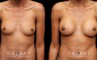 Patient before-and-after photos for breast augmentation with silicone implants. Patient increased cup size while maintaining a natural, balanced look to the breasts.