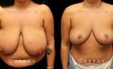 Patient 02 Front View Breast Reduction with Lift Gabbay Plastic Surgery