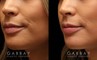 Patient 11 3/4th Left Side View Lip Augmentation Gabbay Plastic Surgery