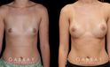 Before and after silicone breast implants for breast augmentation. Note the natural slope to the breasts and the symmetrical appearance while still increasing overall size.