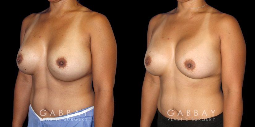 Procedures Depicted:  Breast Revision