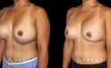 Procedures Depicted:  Breast Revision