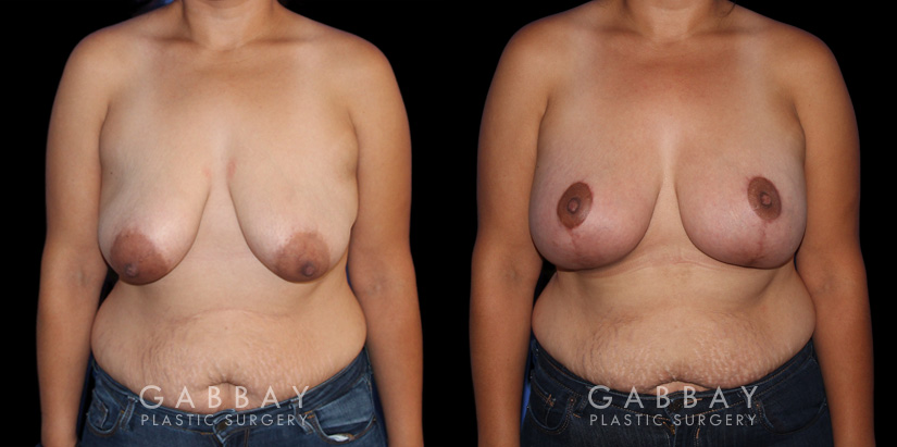 Procedures Depicted:  Breast Augmentation – Silicone, Mastopexy