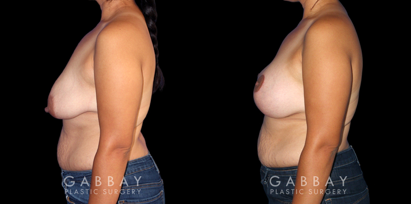 Procedures Depicted:  Breast Augmentation – Silicone, Mastopexy