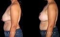 Procedures Depicted:  Breast Augmentation – Silicone, Mastopexy