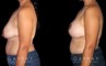 Procedures Depicted:  Breast Augmentation – Silicone, Mastopexy