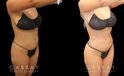Post-op photos of BBL surgery combined with body contouring liposuction of waist, back, and abdomen. 360 fat removal resulted in a slimmer waist contour all around, enhancing figure to show a dynamic volume increase of the butt with lifted position while standing in a relaxed posture. Patient reported a comfortable recovery without complications.