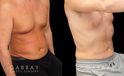 Male liposuction results before and after the procedure, showing the tighter abdomen. Note the significant improvement shown when sitting, showcasing the reduced belly fat from lipo.
