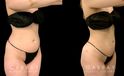 Liposuction results for fat removal along the tailbone, waist, and abdomen, resulting in emphasis of natural curves for a youthful, rejuvenating aesthetic to become visible.