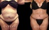 Tummy tuck patient results after abdominal tightening and liposuction to remove loose skin and stubborn pockets of fat. Note the complete tightening of back rolls, resulting in a smoother profile.