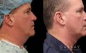 Male neck liposuction results for mid 50s man. Photos demonstrate the contour around the jawline for an overall enhanced masculine jawline contour. Though subtle and refined, the results are noticeable from multiple angles.