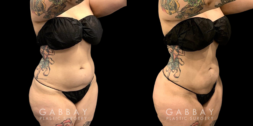 Procedures Depicted:  Abdomen Lipo Female liposuction results for a flatter abdomen. Note how fat reduction was done with her natural figure in mind for results that match her unique features.