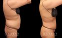 Patient showcasing results of abdominal tightening and liposuction to the abdomen, waist, and flanks. Photos show a restoration of the patient’s natural figure with curves and shape.