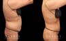 Patient showcasing results of abdominal tightening and liposuction to the abdomen, waist, and flanks. Photos show a restoration of the patient’s natural figure with curves and shape.