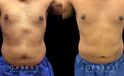 Male patient after surgical removal of abdominal fat. His liposuction results emphasize the naturally masculine form of his torso with a tighter figure overall.