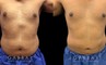 Male patient after surgical removal of abdominal fat. His liposuction results emphasize the naturally masculine form of his torso with a tighter figure overall.