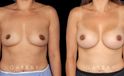 Silicone implants used to increase breast volume while keeping a natural shape. Patient healed well with no complications.