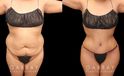 Patient showcasing results of abdominal tightening and liposuction to the abdomen, waist, and flanks. Photos show a restoration of the patient’s natural figure with curves and shape.