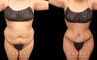Patient showcasing results of abdominal tightening and liposuction to the abdomen, waist, and flanks. Photos show a restoration of the patient’s natural figure with curves and shape.
