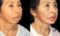 Patient 02 3/4th Right Side View Chin Implant, facelift, Bleph Gabbay Plastic Surgery
