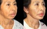 Patient 02 3/4th Right Side View Chin Implant, facelift, Bleph Gabbay Plastic Surgery