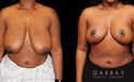 Patient 01 Front View Breast Reduction with Lift Gabbay Plastic Surgery