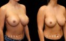 Patient 02 3/4th Right Side View Breast Revision Gabbay Plastic Surgery
