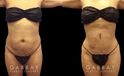 Female patient before and after belly liposuction, enhancing her figure while providing a flatter stomach visible from the side and front. Note the lack of visible scarring.
