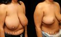 Procedures Depicted:  Breast reduction with lift