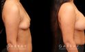 Photos for female patient before and after silicone implant procedure. Note the robust increase in breast size while continuing to match her body’s aesthetic for an aligned appearance.