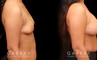 Photos for female patient before and after silicone implant procedure. Note the robust increase in breast size while continuing to match her body’s aesthetic for an aligned appearance.