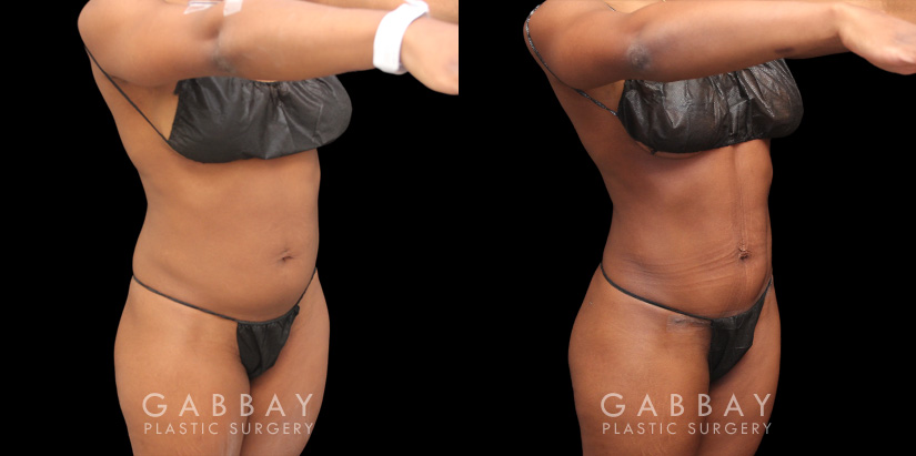 Patient 05 Front View Mini Tummy Tuck Gabbay Plastic Surgery