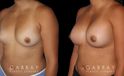Breast Augmentation before-and-after photos demonstrating increased breast volume using silicone implants. Patient sought a milder increase to bust while keeping the volume within a natural range.
