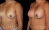 Breast Augmentation before-and-after photos demonstrating increased breast volume using silicone implants. Patient sought a milder increase to bust while keeping the volume within a natural range.