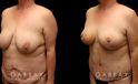 Procedures Depicted:  Tummy Tuck and Breast lift