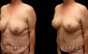 Procedures Depicted:  Tummy Tuck and Breast lift