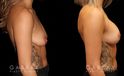 Procedures Depicted:  Mastopexy with Breast Augmentation