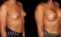 This is a young woman with a tuberous or constricted breast deformity. The lower portion of the breast developed more tightly than the rest of the breast. She wanted a more full, but natural breast appearance. She had silicone breast augmentation, with placement of an Allergan naturelle soft touch silicone breast implant through a lower breast/inframammary fold incision. Her moderate profile implants were 310 cc. Patients like this are prone to lower breast complications such as a double bubble, but with careful performance of the operation, she easily avoided this complication.