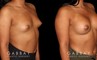 This is a young woman with a tuberous or constricted breast deformity. The lower portion of the breast developed more tightly than the rest of the breast. She wanted a more full, but natural breast appearance. She had silicone breast augmentation, with placement of an Allergan naturelle soft touch silicone breast implant through a lower breast/inframammary fold incision. Her moderate profile implants were 310 cc. Patients like this are prone to lower breast complications such as a double bubble, but with careful performance of the operation, she easily avoided this complication.