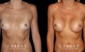 Breast augmentation before-and-after photos for patient with silicone implants. Increased volume resulted in pleasantly round breasts without excessive change.