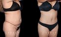 Photos of patient results after a combination of multiple liposuction procedures, each targeting a different area. Liposuction of the back bra roll, arms, and Buffalo hump augmented by abdominal tightening produced a flat, tighter torso from each angle.