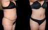 Photos of patient results after a combination of multiple liposuction procedures, each targeting a different area. Liposuction of the back bra roll, arms, and Buffalo hump augmented by abdominal tightening produced a flat, tighter torso from each angle.