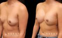 Photos of breast augmentation patient results, including before procedure and after once the patient fully recovered. Increased breast roundness allowed for the patient to see an unique aesthetic.