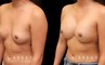 Photos of breast augmentation patient results, including before procedure and after once the patient fully recovered. Increased breast roundness allowed for the patient to see an unique aesthetic.