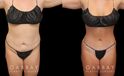 Patient before and after abdominoplasty from multiple angles. Not the improvements while standing and seated, removing the effect of bunching skin and stomach fat, and restoring a flat tightness to the area.