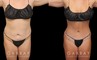 Patient before and after abdominoplasty from multiple angles. Not the improvements while standing and seated, removing the effect of bunching skin and stomach fat, and restoring a flat tightness to the area.